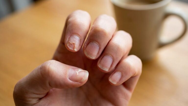 Why Do Nails Break Easily – Understanding Causes and Prevention Tips Why Do Nails Break Easily