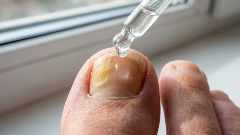 10 Best Essential Oil for Nail Fungus Effective Remedies and Usage Guide best essential oil for nail fungus