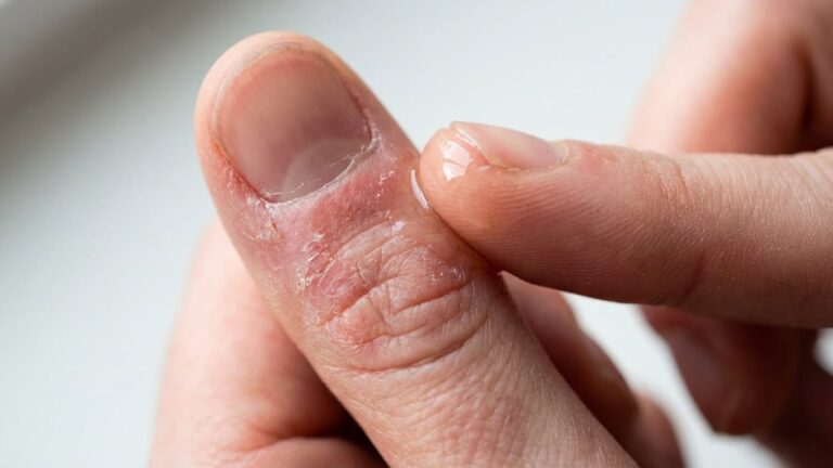 10 Best Cuticle Oil for Eczema Soothing and Effective Solutions best cuticle oil for eczema