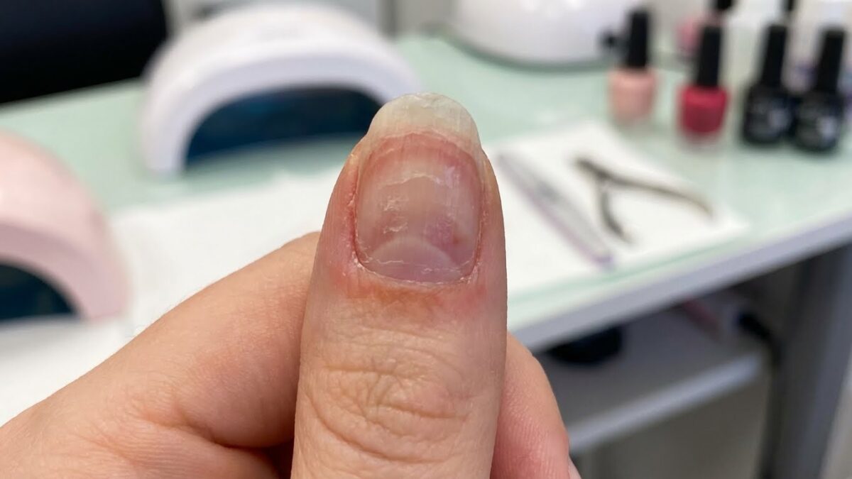Why Do My Fake Nails Hurt: Causes, Prevention, and Treatment Options ...