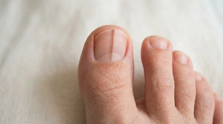 What Does a Dark Line on a Toenail Mean