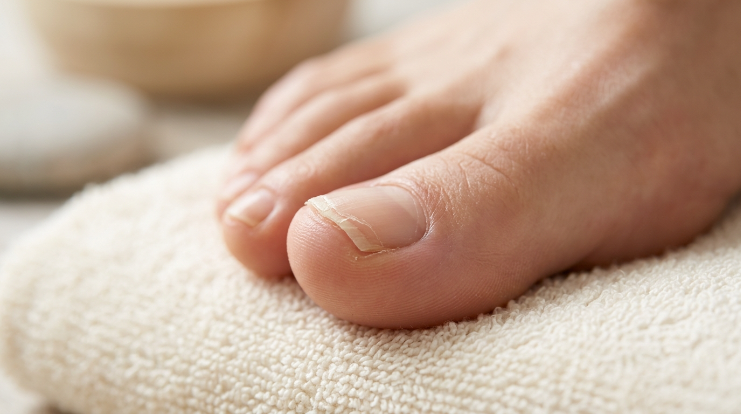 Why are my toenails peeling at the edges