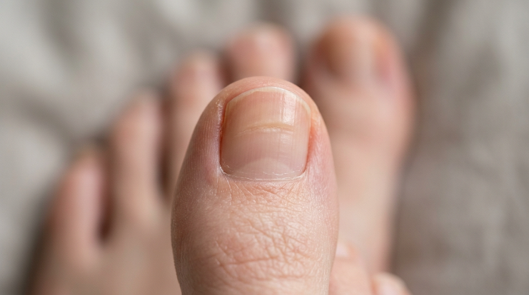 What causes horizontal ridges in toenails showing a visible Beau’s line