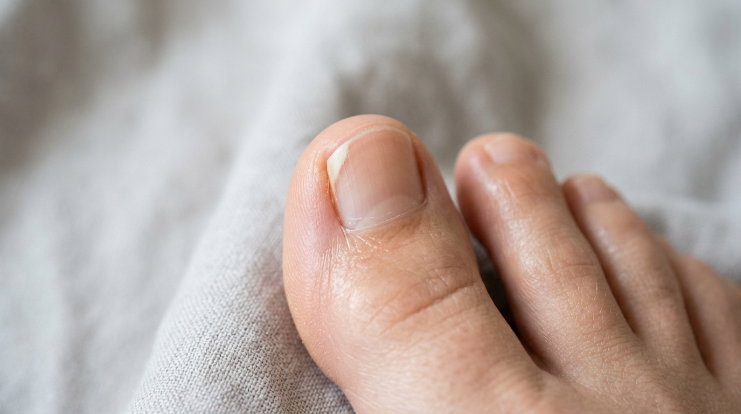 Why is my toenail lifting from the nail bed example showing mild nail separation