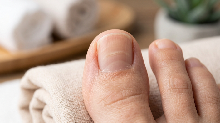 Why does my toenail have a dent horizontal groove example