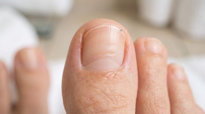 Why does my toenail have a line across it showing a horizontal toenail groove