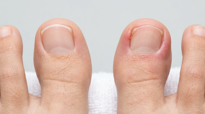 Ingrown toenail vs normal toenail visual comparison showing common differences
