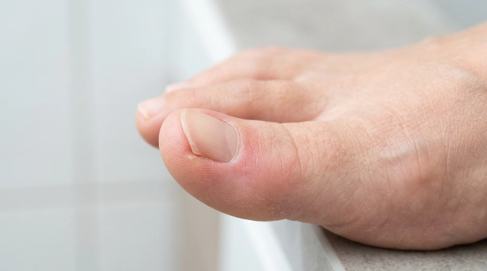 What does an ingrown toenail look like on a big toe