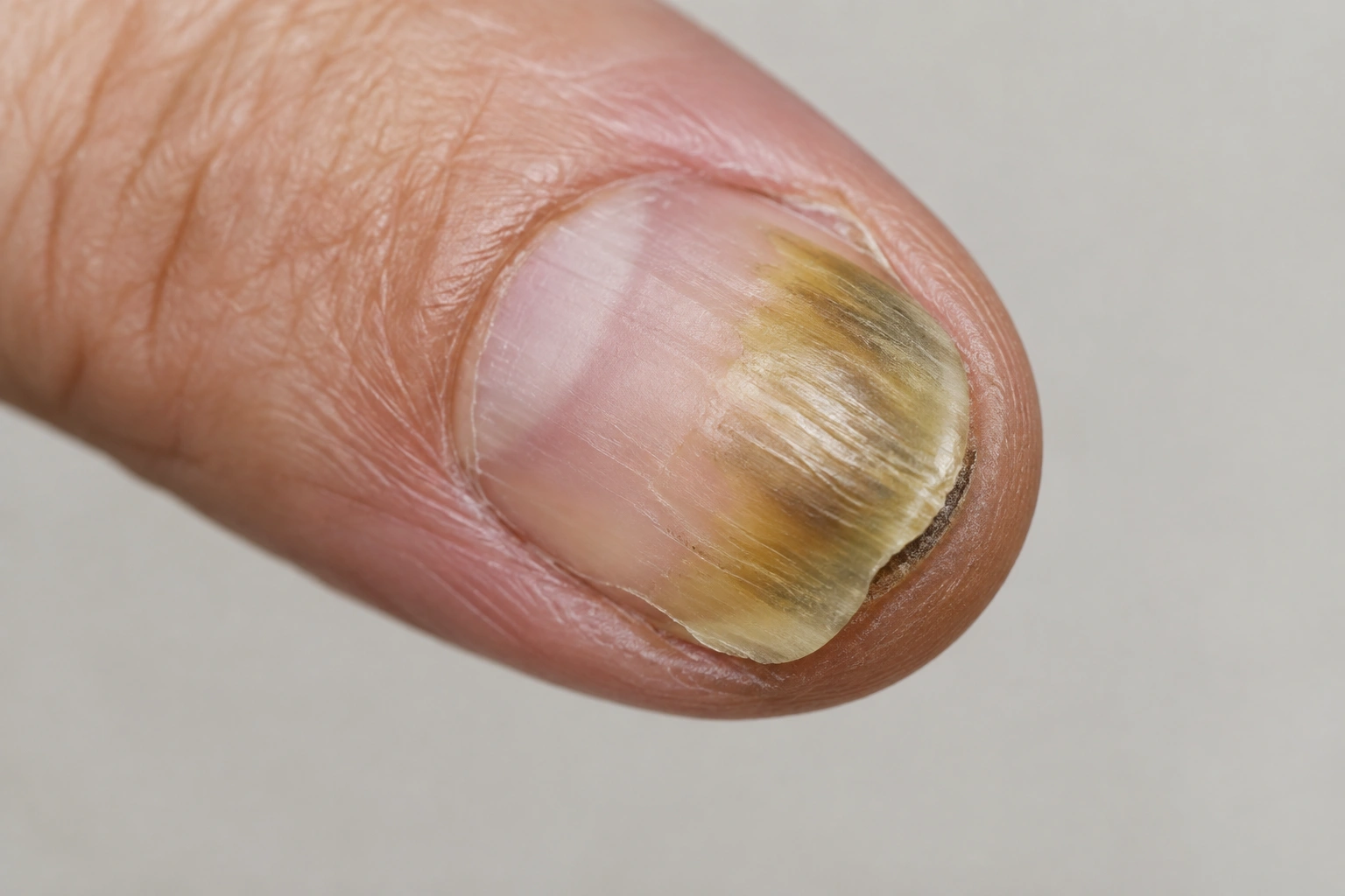 Close-up of a nail with discoloration and lifting that should be checked by a dermatologist