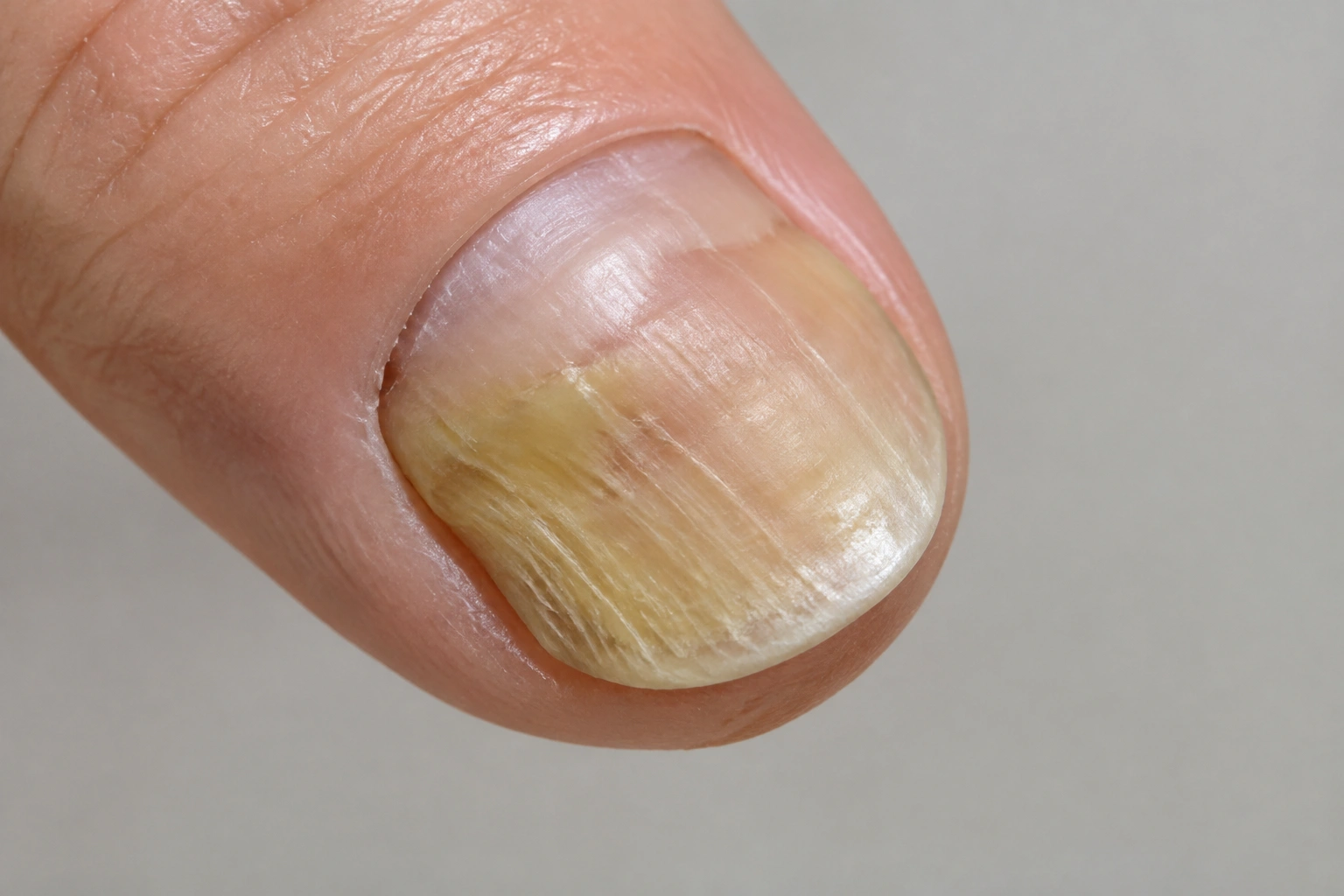 Close-up of a fingernail with discoloration needing medical attention